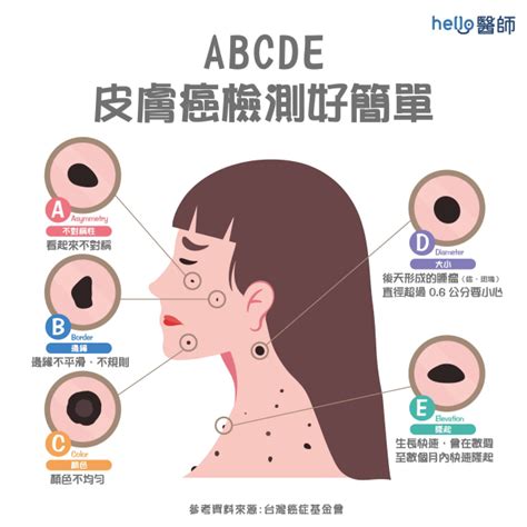 身體很多痣|皮膚長痣、長斑是皮膚癌前兆？皮膚癌初期4大症狀快。